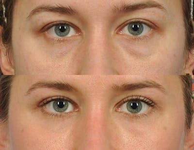 Fillers Before & After Gallery - Patient 386147 - Image 1