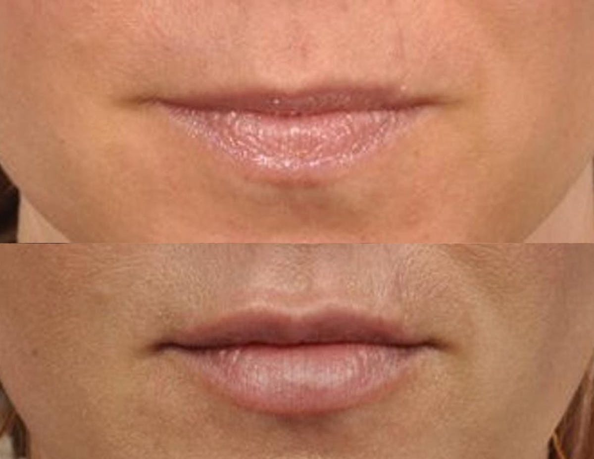 Fillers Before & After Gallery - Patient 275239 - Image 1