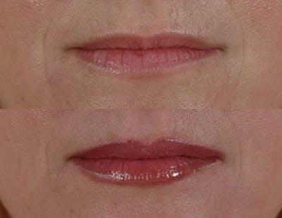Fillers Before & After Gallery - Patient 829175 - Image 2