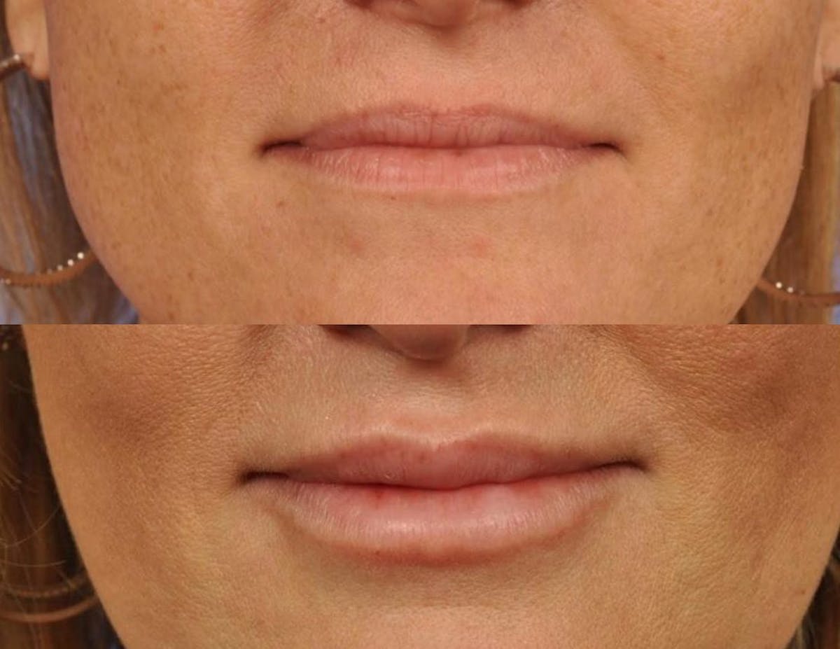 Fillers Before & After Gallery - Patient 281637 - Image 1