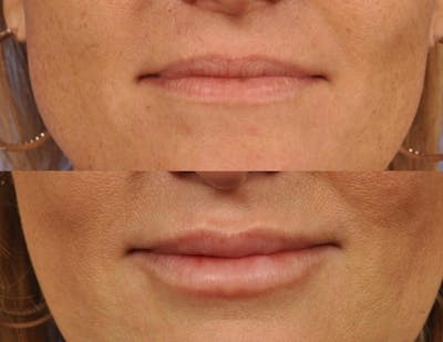 Fillers Before & After Gallery - Patient 281637 - Image 1