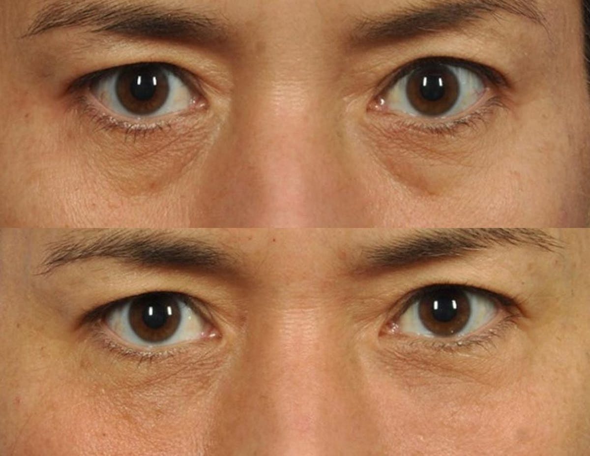 Fillers Before & After Gallery - Patient 210173 - Image 1