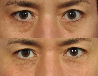 Fillers Before & After Gallery - Patient 210173 - Image 1