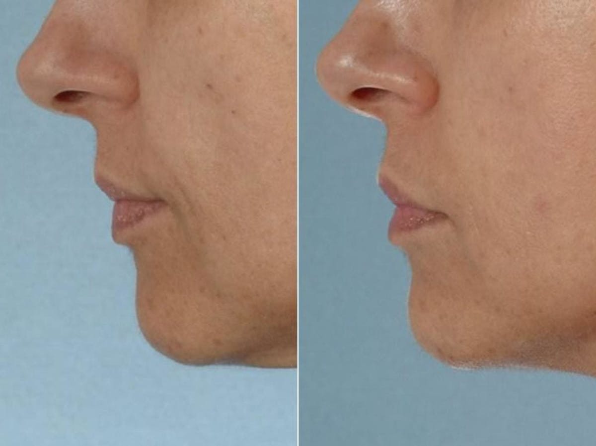 Fillers Before & After Gallery - Patient 214068 - Image 1