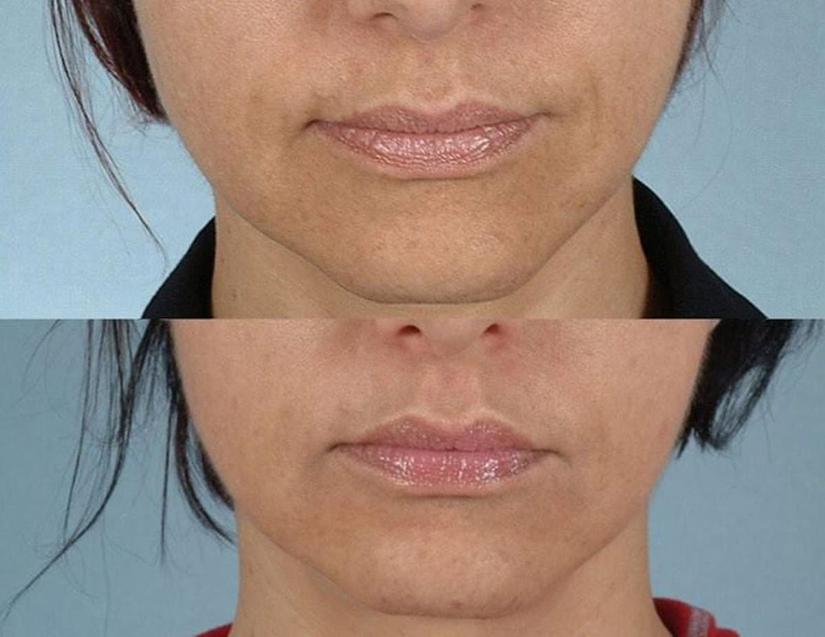 Fillers Before & After Gallery - Patient 100273 - Image 1