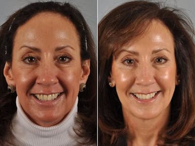Fillers Before & After Gallery - Patient 182120 - Image 1