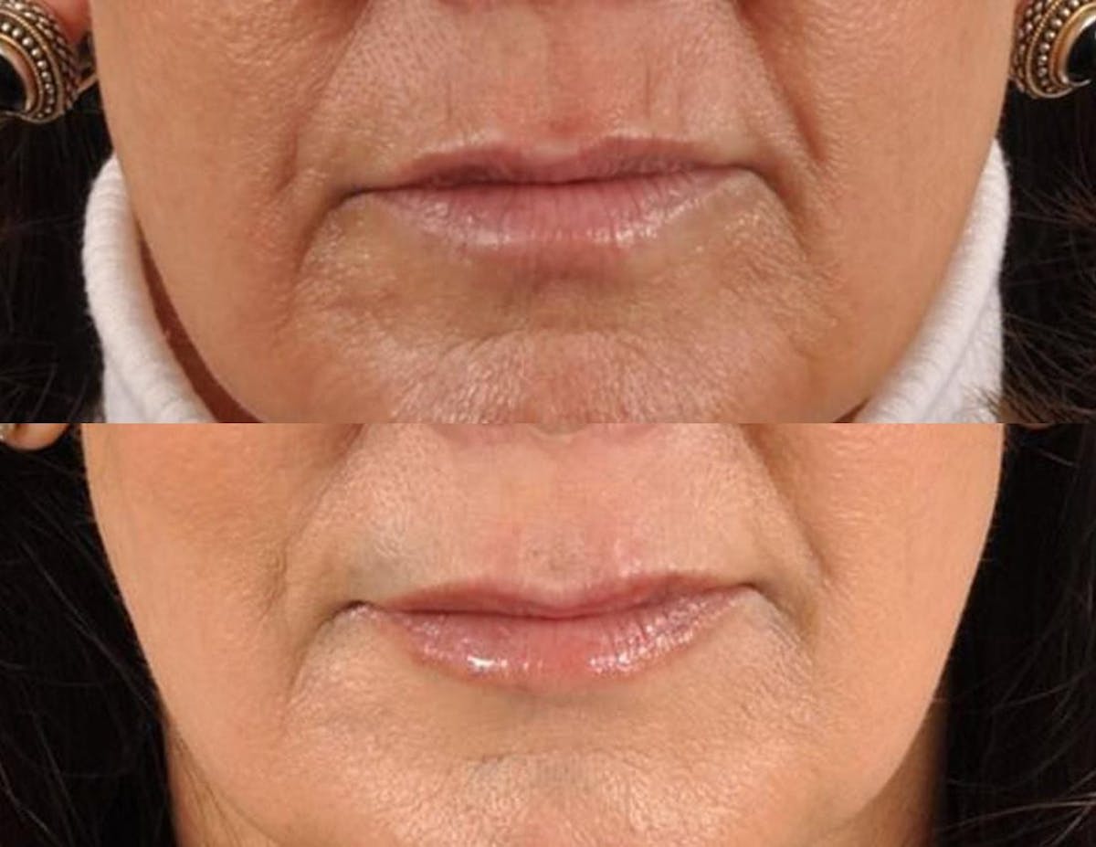 Fillers Before & After Gallery - Patient 182120 - Image 3