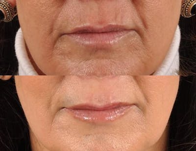 Fillers Before & After Gallery - Patient 182120 - Image 3