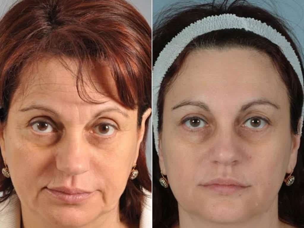 Fillers Before & After Gallery - Patient 792519 - Image 1