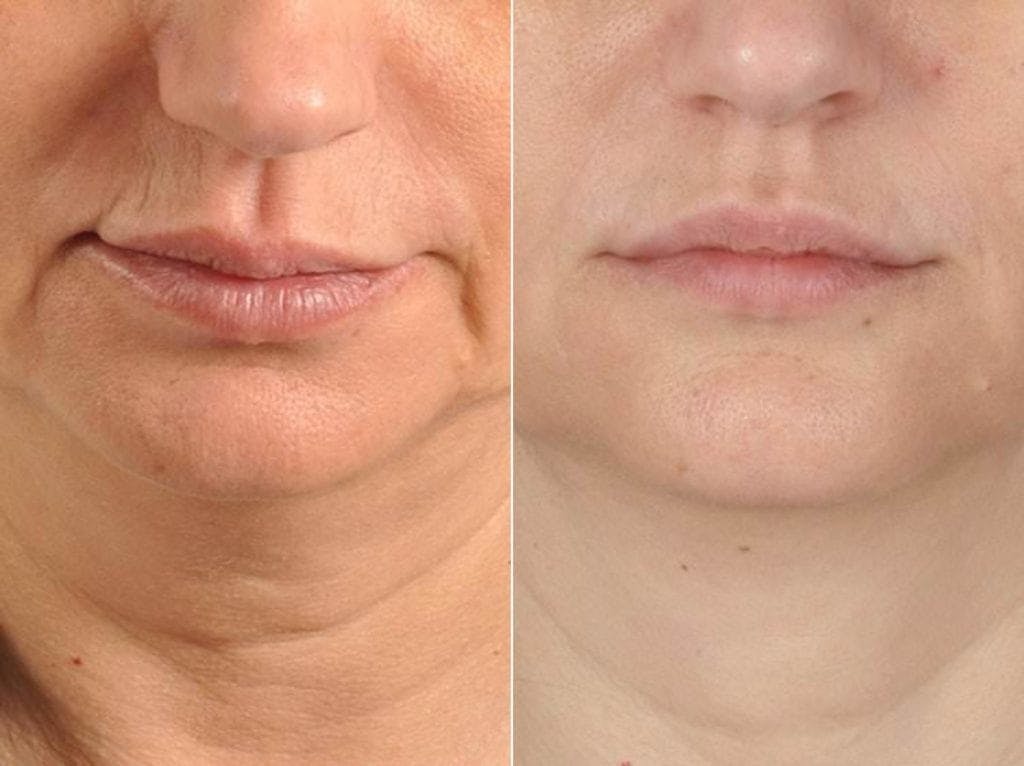 Fillers Before & After Gallery - Patient 792519 - Image 2