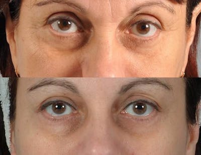 Fillers Before & After Gallery - Patient 792519 - Image 3