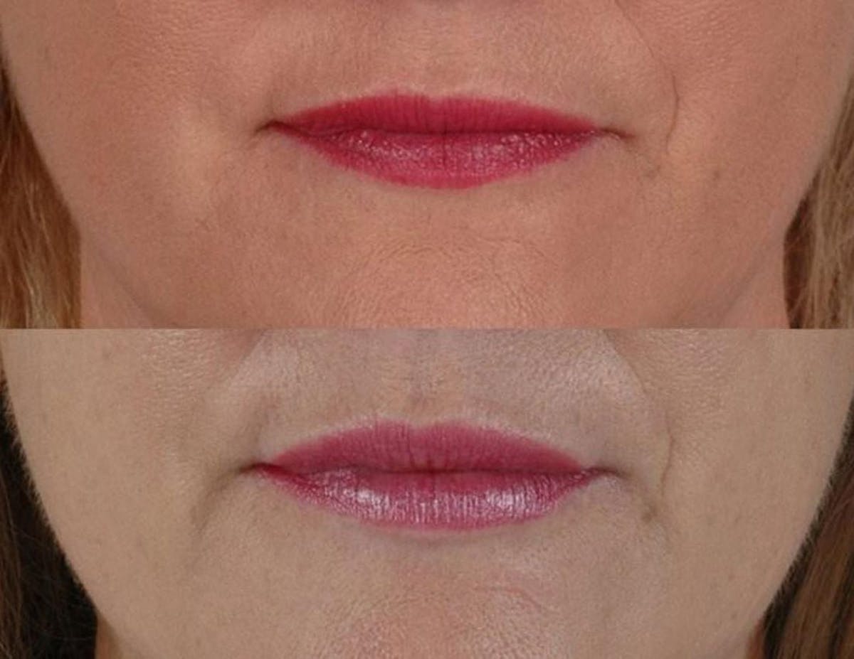 Fillers Before & After Gallery - Patient 594377 - Image 1