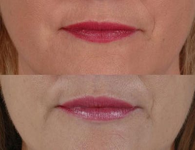 Fillers Before & After Gallery - Patient 594377 - Image 1