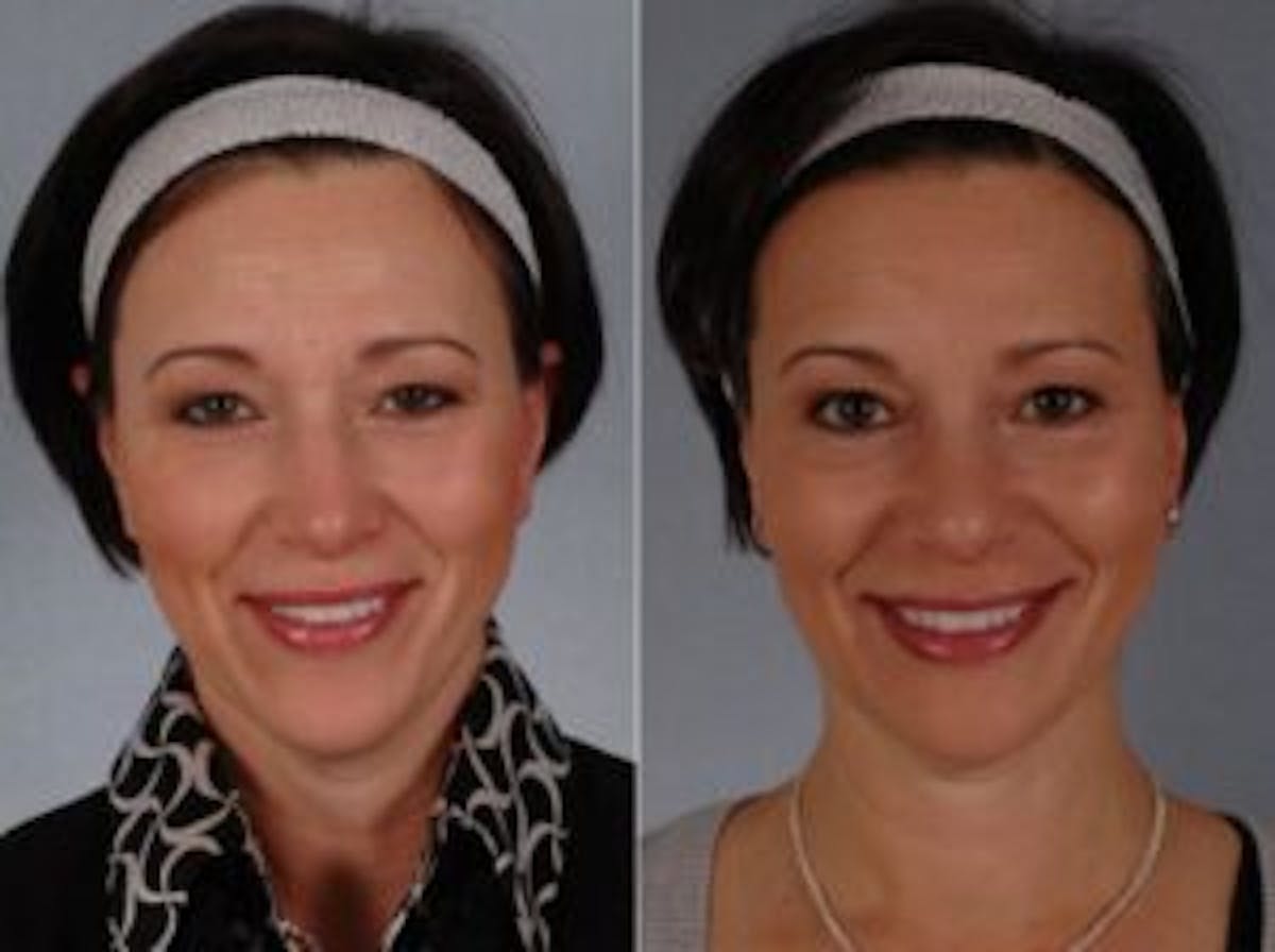 Fillers Before & After Gallery - Patient 770156 - Image 1
