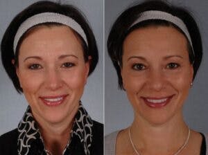Fillers Before & After Gallery - Patient 770156 - Image 1