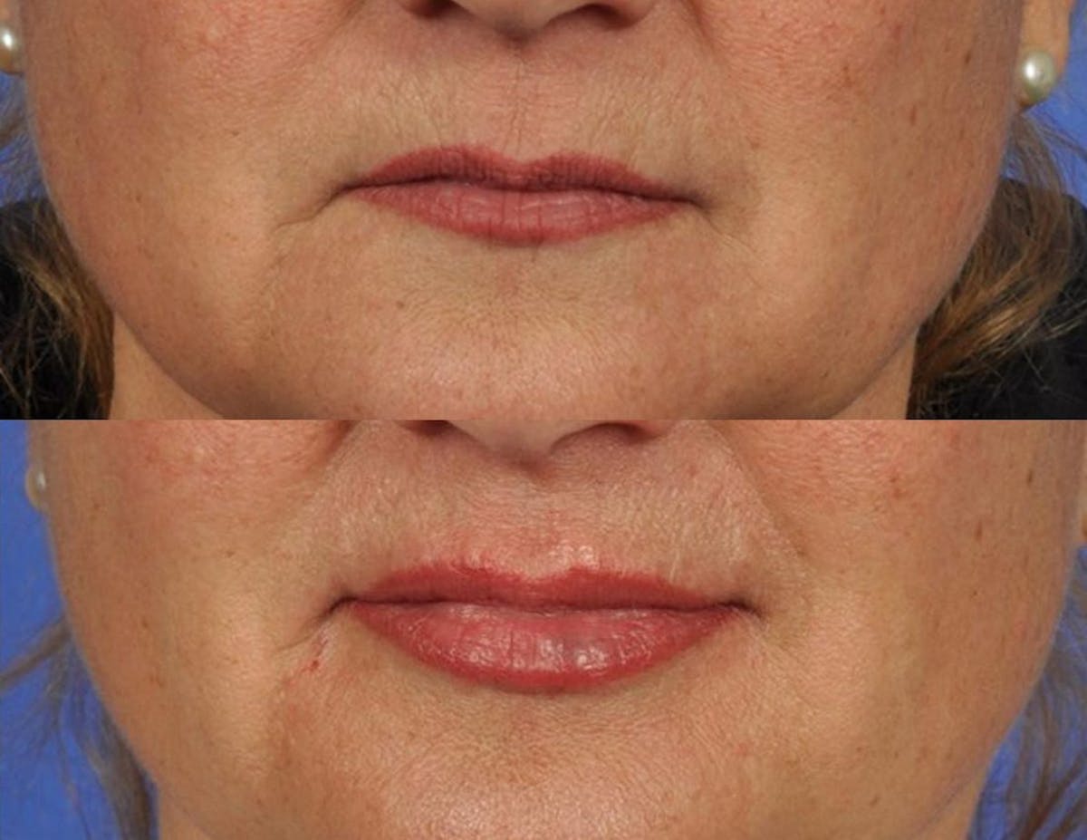 Fillers Before & After Gallery - Patient 511642 - Image 1