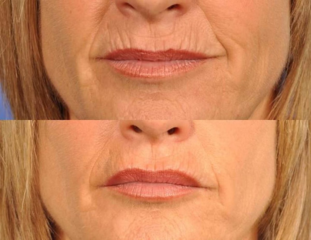 Fillers Before & After Gallery - Patient 256042 - Image 1
