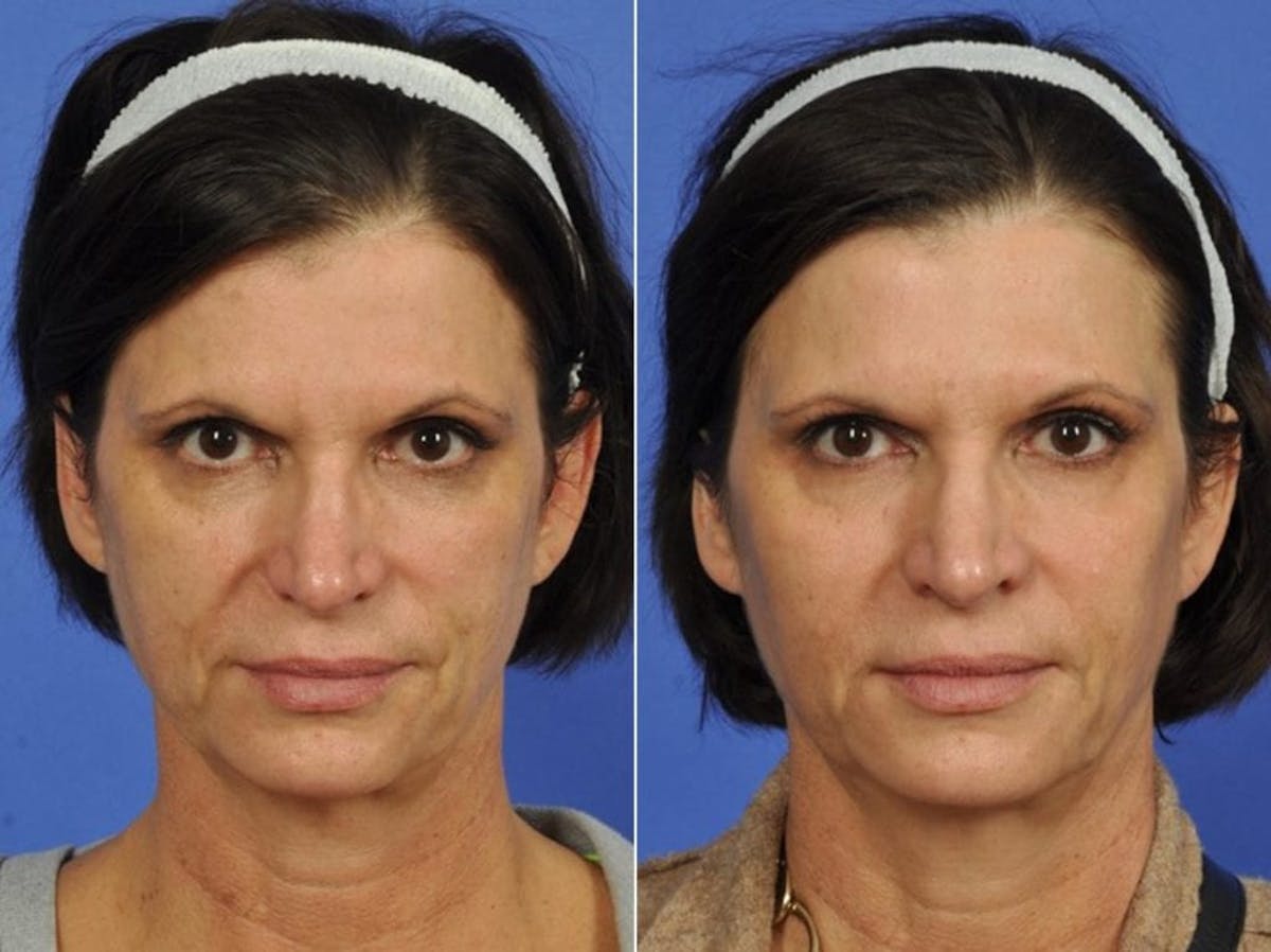 Fillers Before & After Gallery - Patient 849200 - Image 1