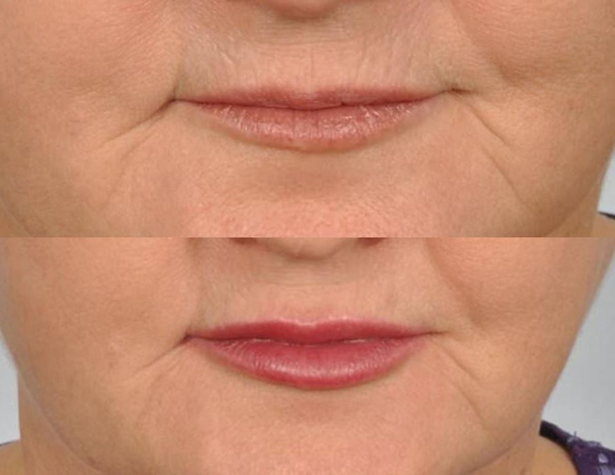 Fillers Before & After Gallery - Patient 340408 - Image 1