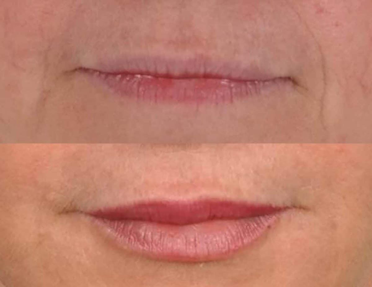 Fillers Before & After Gallery - Patient 962970 - Image 1