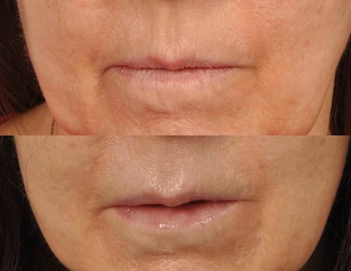 Fillers Before & After Gallery - Patient 408419 - Image 1