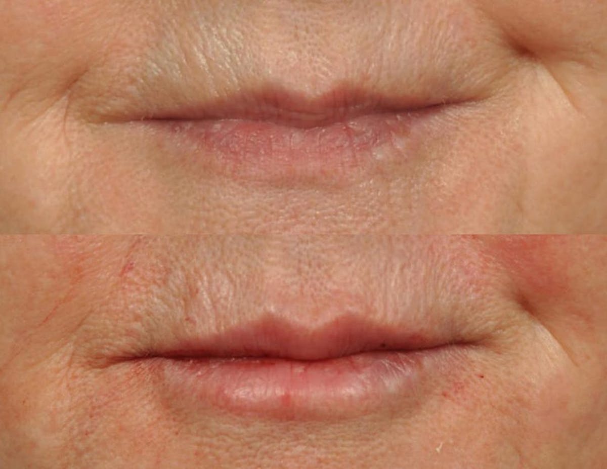 Fillers Before & After Gallery - Patient 149437 - Image 1