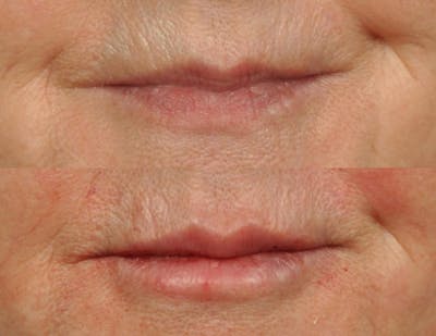 Fillers Before & After Gallery - Patient 149437 - Image 1