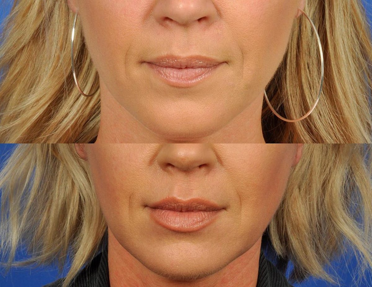 Fillers Before & After Gallery - Patient 411229 - Image 1