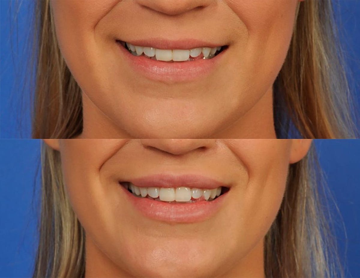 Fillers Before & After Gallery - Patient 240230 - Image 1