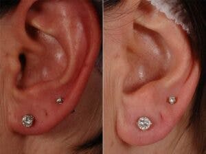 Fillers Before & After Gallery - Patient 113020 - Image 1