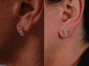 Fillers Before & After Gallery - Patient 113020 - Image 2