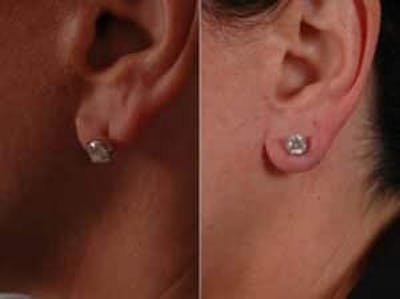 Fillers Before & After Gallery - Patient 113020 - Image 2