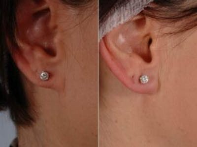 Fillers Before & After Gallery - Patient 113020 - Image 3