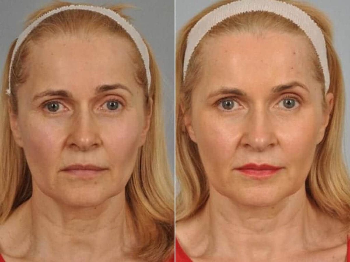 Fillers Before & After Gallery - Patient 300943 - Image 1