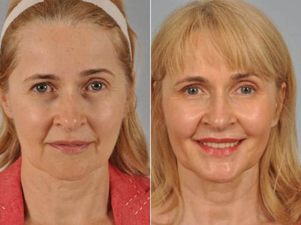 Fillers Before & After Gallery - Patient 300943 - Image 2