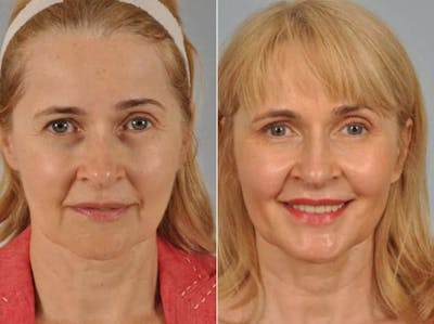 Fillers Before & After Gallery - Patient 300943 - Image 2
