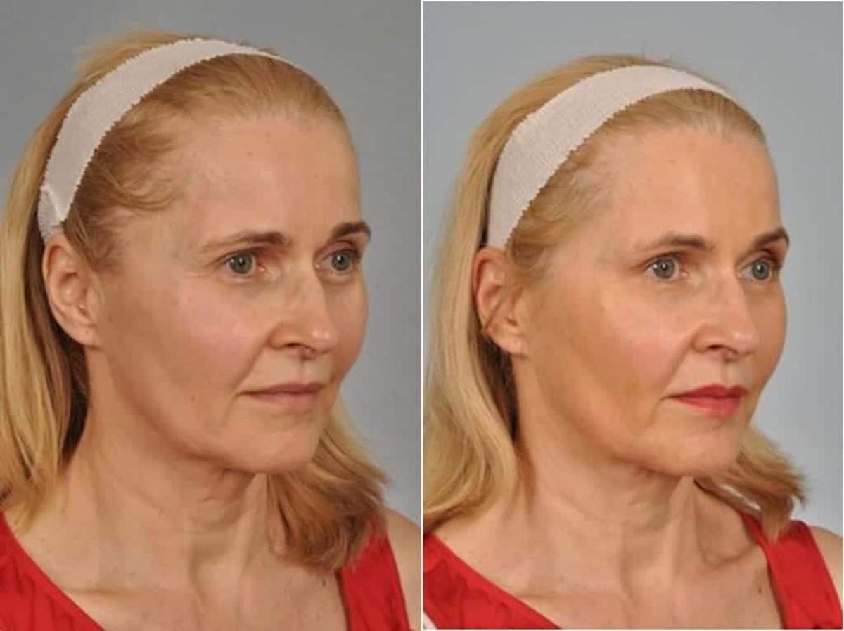 Fillers Before & After Gallery - Patient 300943 - Image 3
