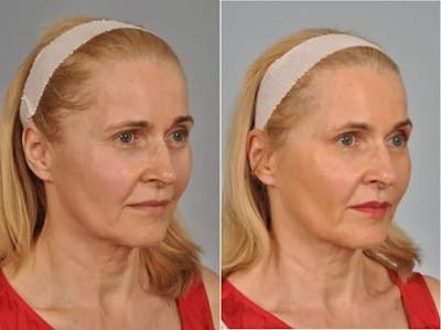 Fillers Before & After Gallery - Patient 300943 - Image 3
