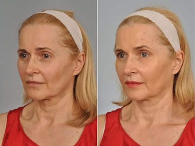 Fillers Before & After Gallery - Patient 300943 - Image 4
