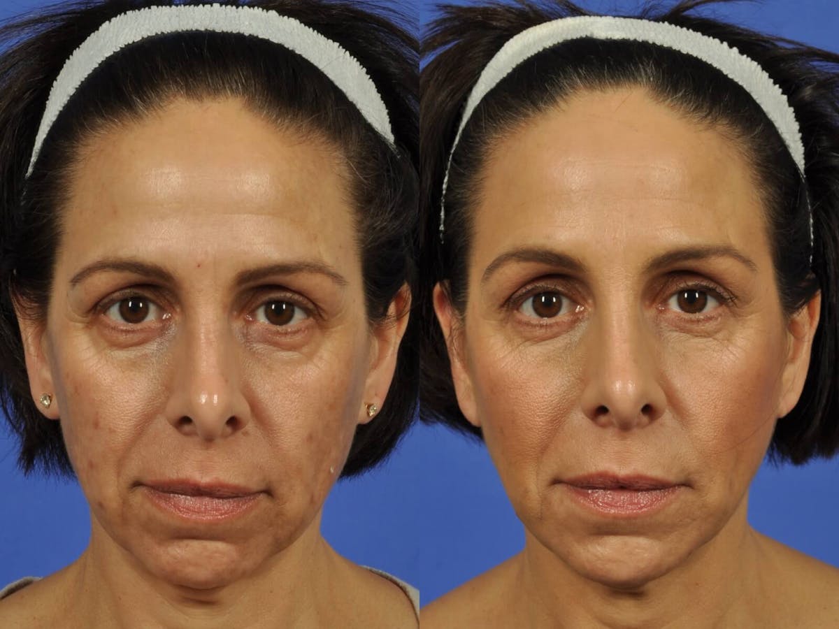 Tear Trough Filler Before & After Gallery - Patient 158561 - Image 1