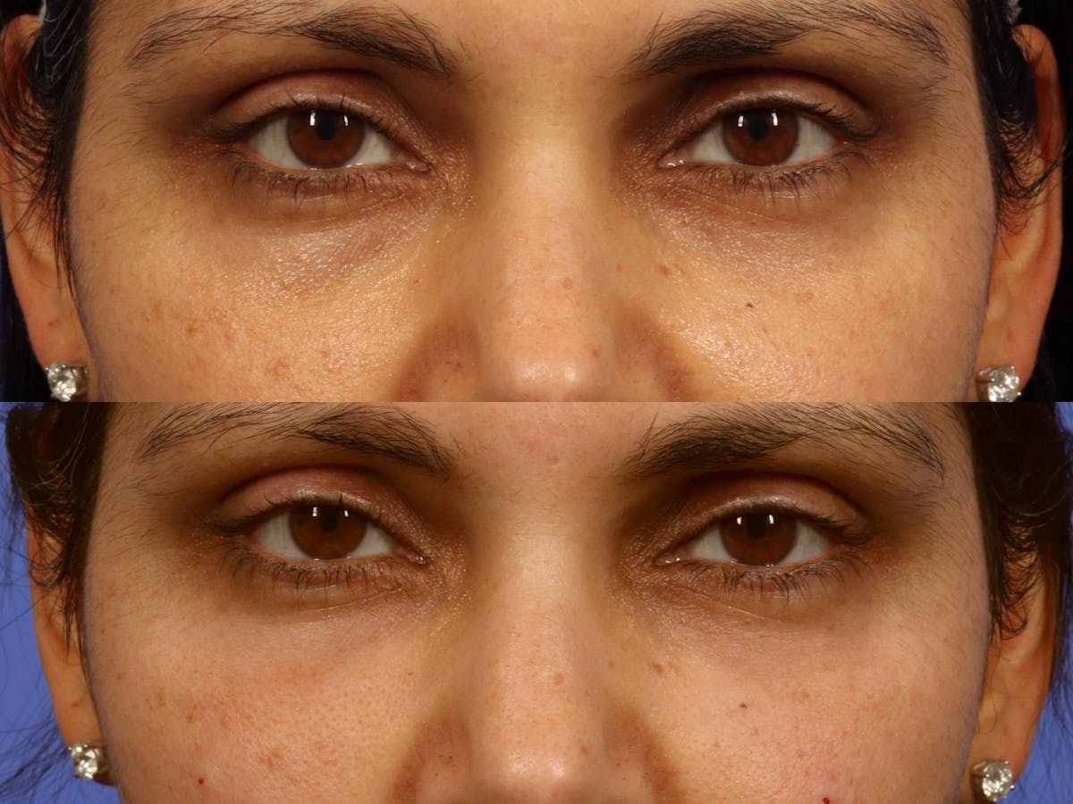 Tear Trough Filler Before & After Gallery - Patient 855977 - Image 1