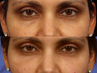Tear Trough Filler Before & After Gallery - Patient 855977 - Image 1