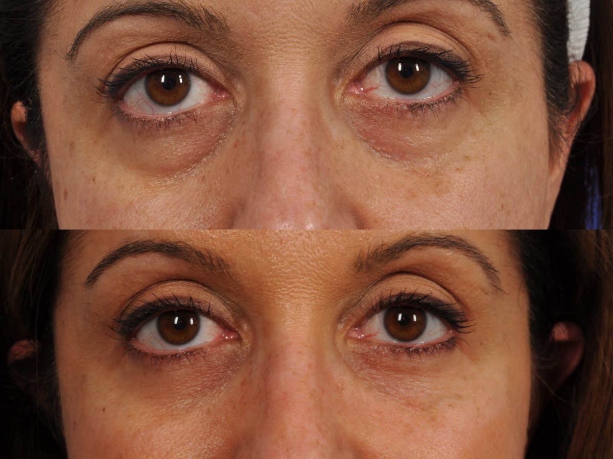 Tear Trough Filler Before & After Gallery - Patient 359480 - Image 1