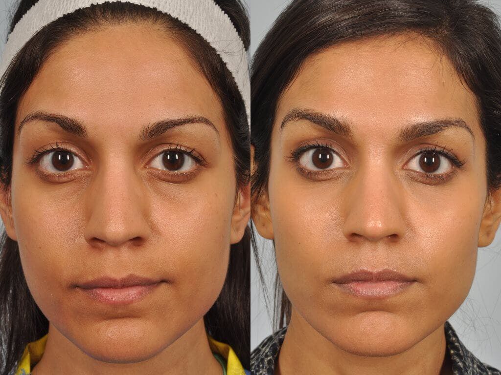 Tear Trough Filler Before & After Gallery - Patient 113809 - Image 1
