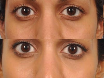 Tear Trough Filler Before & After Gallery - Patient 113809 - Image 2