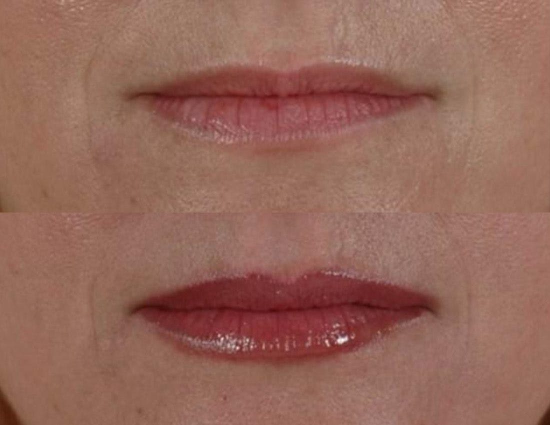 Tear Trough Filler Before & After Gallery - Patient 299115 - Image 2
