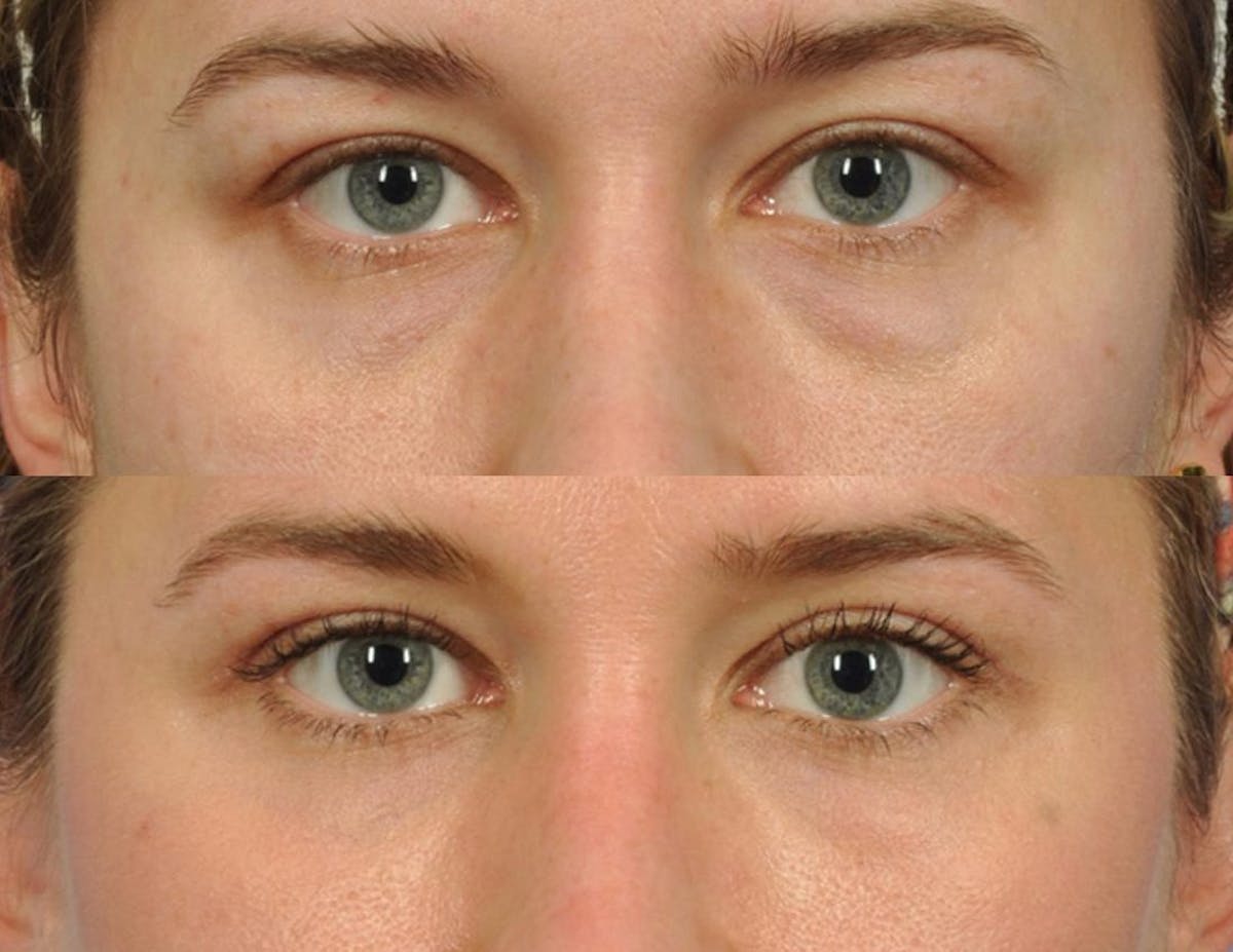 Tear Trough Filler Before & After Gallery - Patient 393307 - Image 1