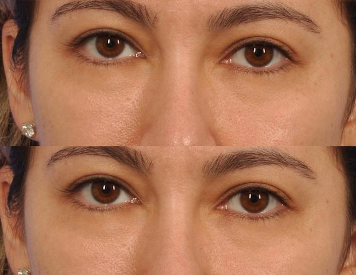 Tear Trough Filler Before & After Gallery - Patient 414114 - Image 1