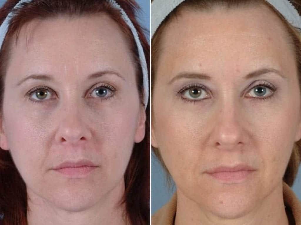 Tear Trough Filler Before & After Gallery - Patient 362911 - Image 1