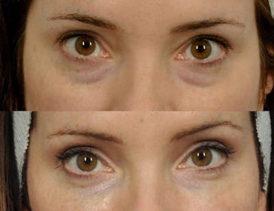 Tear Trough Filler Before & After Gallery - Patient 229750 - Image 2